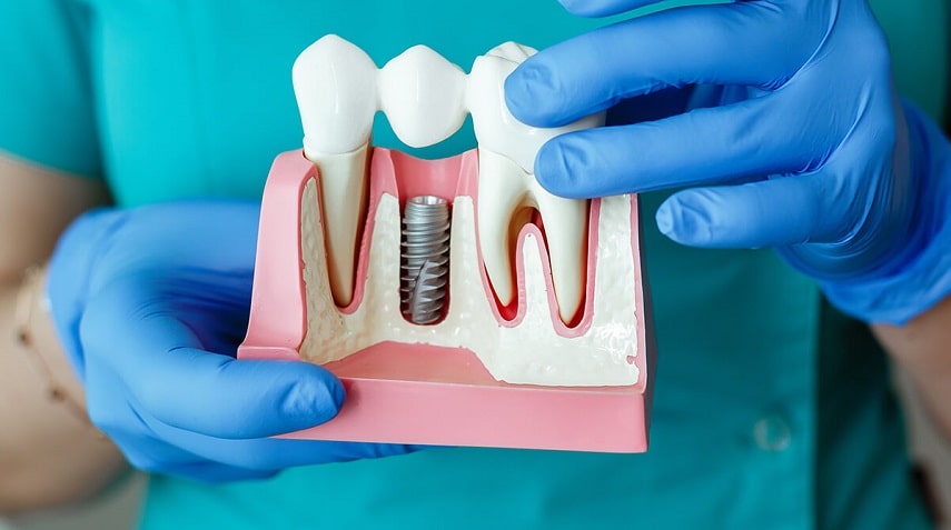 tooth-implant-min Типы зубных имплантатов для протезирования - tooth implant min